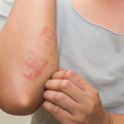 Biduran Tak Kunjung Sembuh? Kenali Penyakit Urtikaria