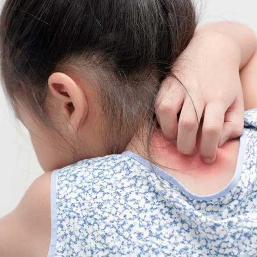 Mengenal Anafilaksis: Reaksi Alergi Berat yang Mengancam Nyawa