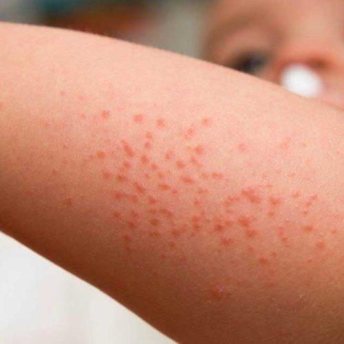 Peradangan Pembuluh Darah: Penjelasan Sederhana Tentang Vaskulitis