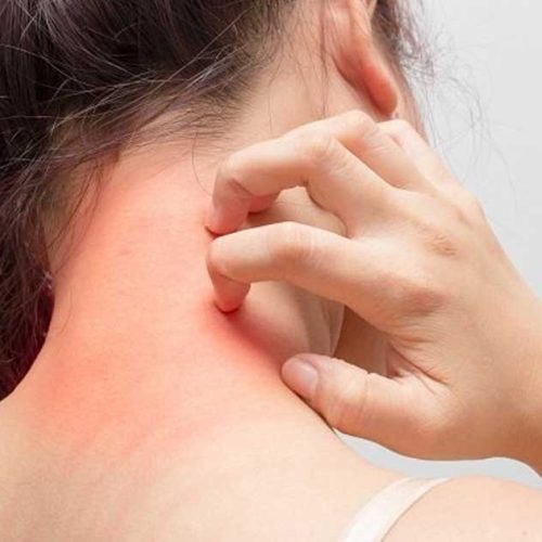 Alergi Antibiotik Beta-Laktam: Apakah berbahaya?