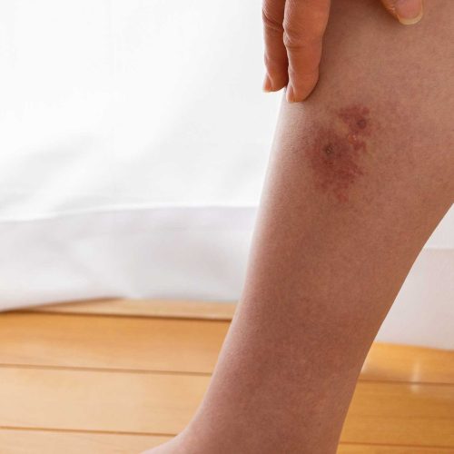 Benjolan Merah yang Nyeri di Kaki: Kenali Eritema Nodosum!