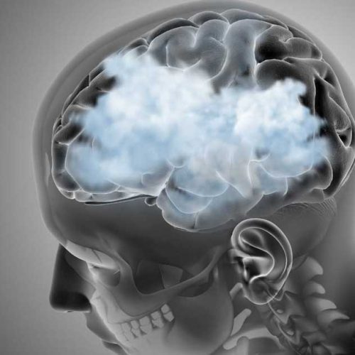 Brain Fog hingga Kejang pada Pasien Lupus: Mengenal Neuropsychiatric Lupus (NPSLE)