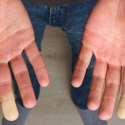 Mengapa Jari Bisa Membiru Saat Dingin? Kenali Fenomena Raynaud