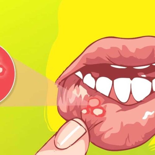 Sariawan Tak Kunjung Sembuh? Kenali Penyakit Behçet Sejak Dini