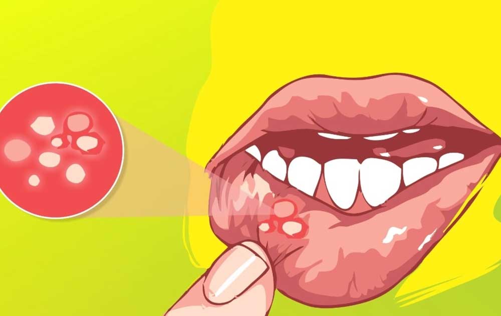 Read more about the article Sariawan Tak Kunjung Sembuh? Kenali Penyakit Behçet Sejak Dini