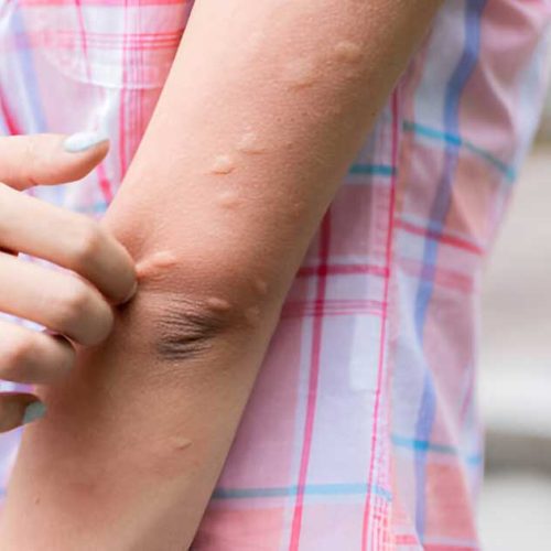 Biduran Tak Kunjung Hilang? Kenali Urtikaria Kronik dan Cara Mengatasinya