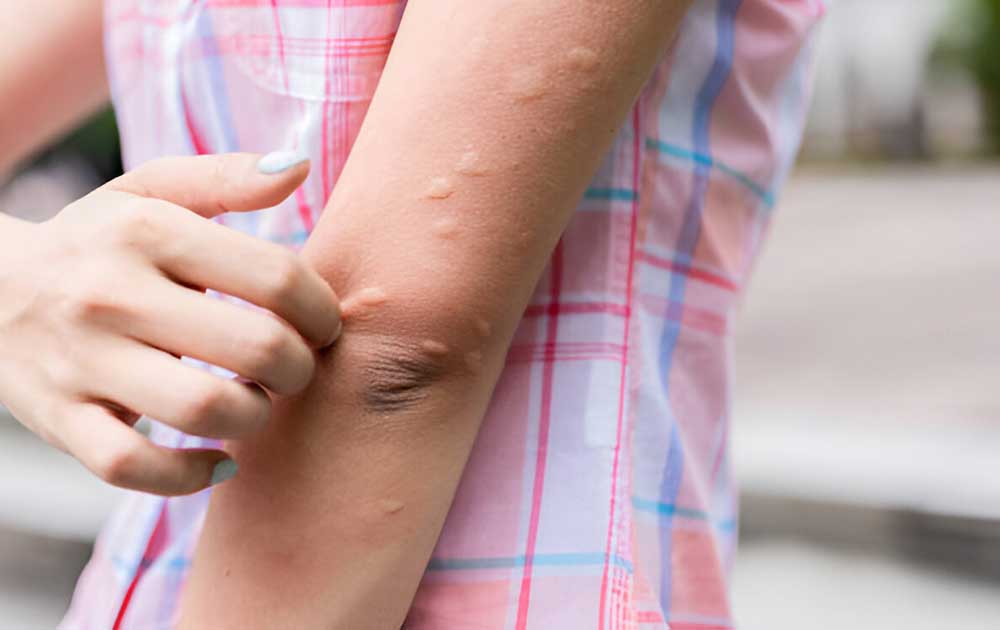 Read more about the article Biduran Tak Kunjung Hilang? Kenali Urtikaria Kronik dan Cara Mengatasinya
