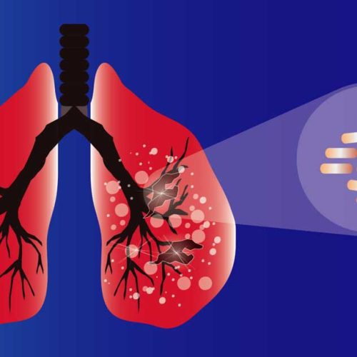 Mengenal Interstitial Lung Disease (ILD) dan Kaitannya dengan Sistem Imun