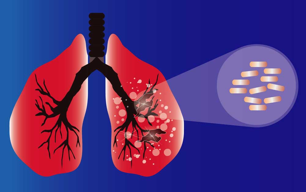 Read more about the article Mengenal Interstitial Lung Disease (ILD) dan Kaitannya dengan Sistem Imun