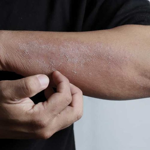 Dermatitis Atopik: Penyakit Kulit Kronis yang Berkaitan dengan Alergi dan Sistem Imun