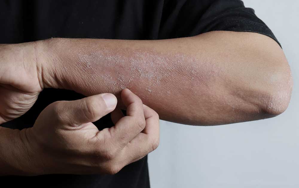 Read more about the article Dermatitis Atopik: Penyakit Kulit Kronis yang Berkaitan dengan Alergi dan Sistem Imun