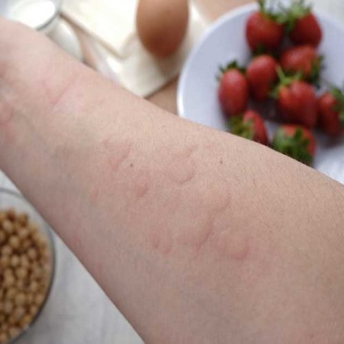 Reaksi Anafilaksis: Saat Alergi menjadi Kondisi Darurat