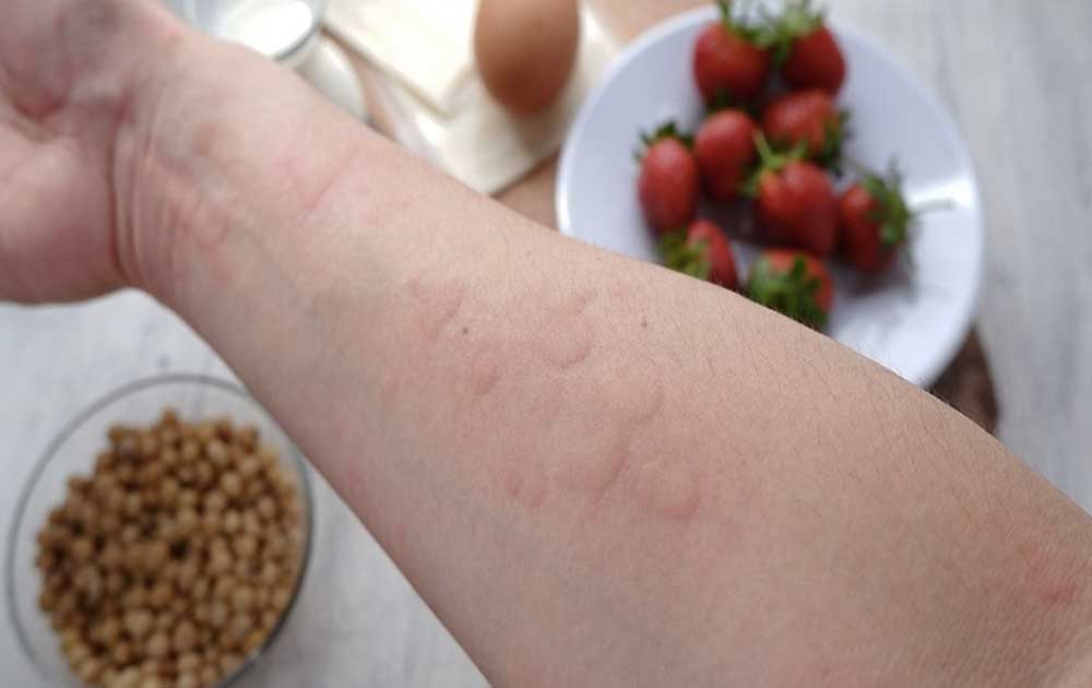 Read more about the article Reaksi Anafilaksis: Saat Alergi menjadi Kondisi Darurat