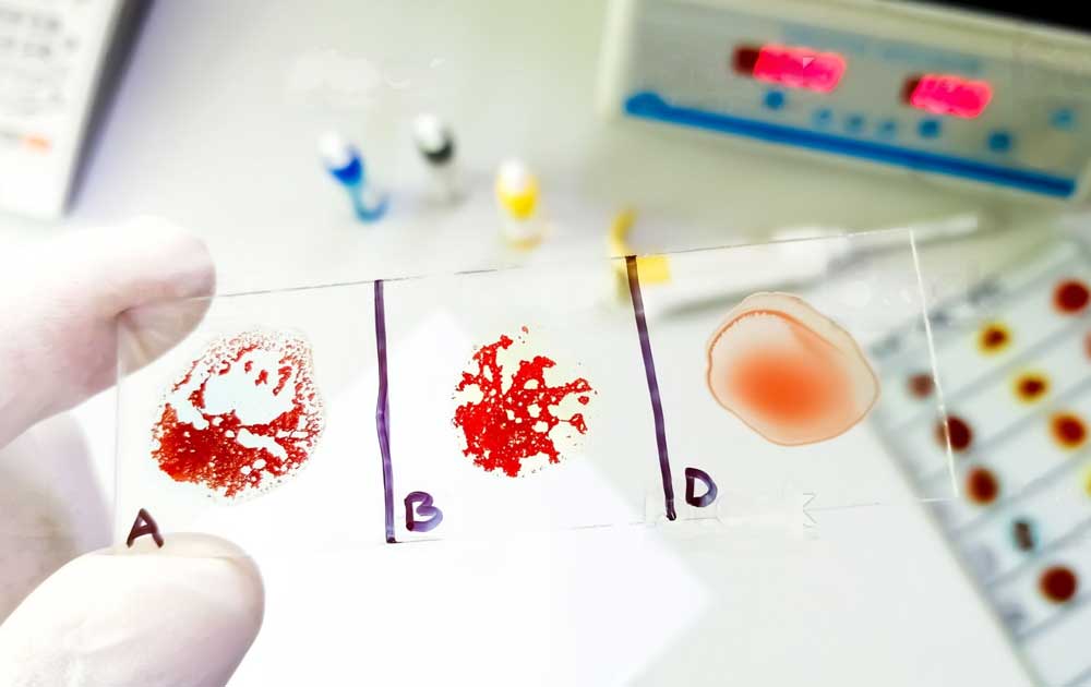 You are currently viewing Inkompatibilitas Golongan Darah: Memahami Reaksi Imun di Baliknya