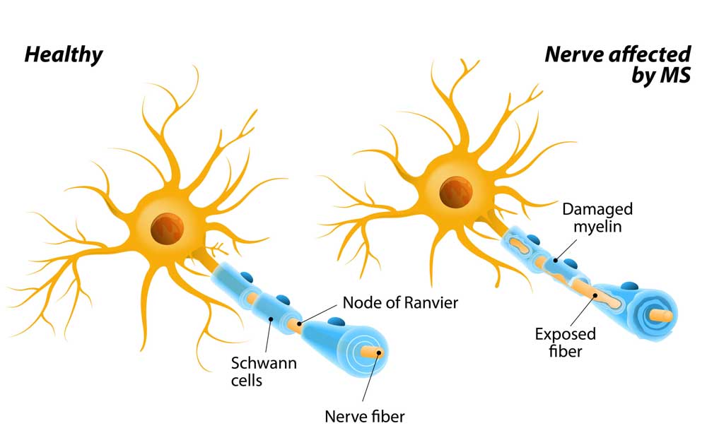 You are currently viewing Multiple Sclerosis: Saat Sistem Imun Menyerang Sistem Saraf