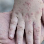 Melindungi Diri dari Campak: Pentingnya Vaksin MMR pada Orang Dewasa