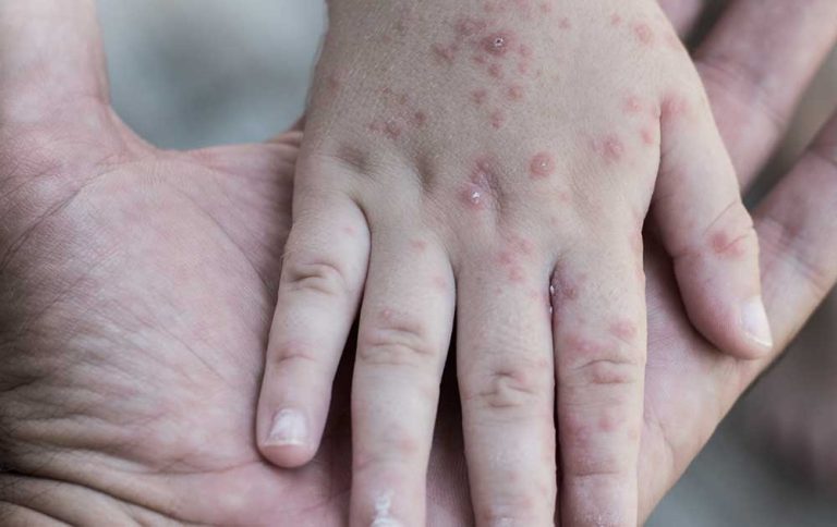 Melindungi Diri dari Campak: Pentingnya Vaksin MMR pada Orang Dewasa