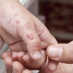 Cacar Api (Herpes Zoster): Ketika Virus Cacar Air “Bangun” Kembali di Usia Dewasa