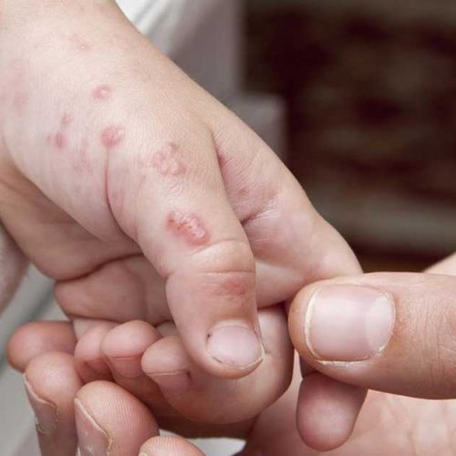 Cacar Api (Herpes Zoster): Ketika Virus Cacar Air “Bangun” Kembali di Usia Dewasa