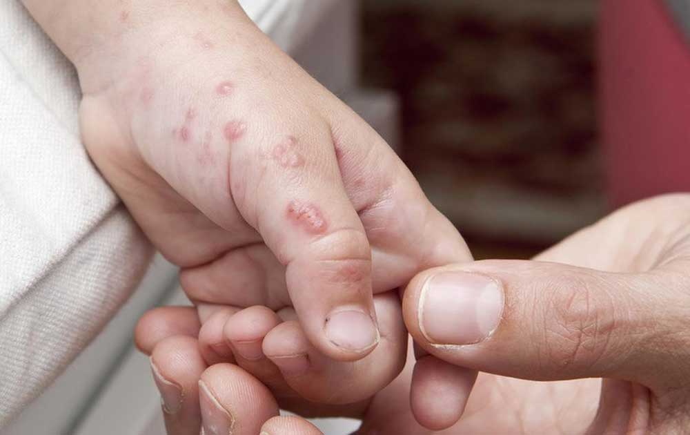 You are currently viewing Cacar Api (Herpes Zoster): Ketika Virus Cacar Air “Bangun” Kembali di Usia Dewasa