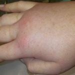 Kenali Hereditary Angioedema: Pembengkakan Bagian Tubuh secara Berulang