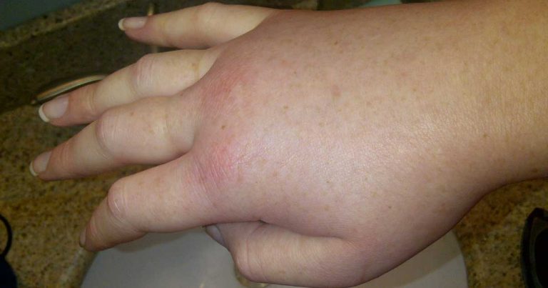 Kenali Hereditary Angioedema: Pembengkakan Bagian Tubuh secara Berulang