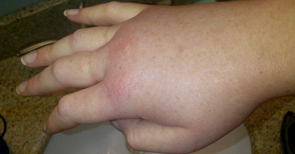 Read more about the article Kenali Hereditary Angioedema: Pembengkakan Bagian Tubuh secara Berulang