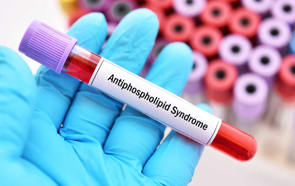 Read more about the article Kenali Antiphospholipid Syndrome: Gangguan Pembekuan Darah akibat Autoimun