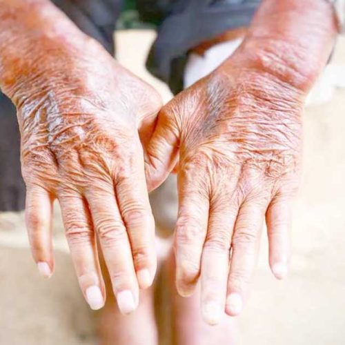 Skleroderma: Kelainan Kulit akibat Proses Autoimun