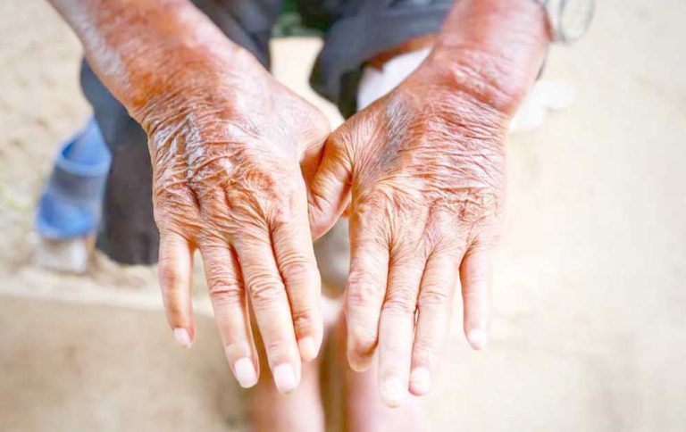 Skleroderma: Kelainan Kulit akibat Proses Autoimun