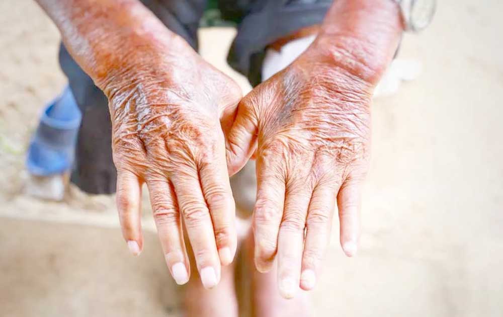 Read more about the article Skleroderma: Kelainan Kulit akibat Proses Autoimun