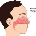 Rinitis Alergi: Reaksi Alergi Berlebihan pada Hidung