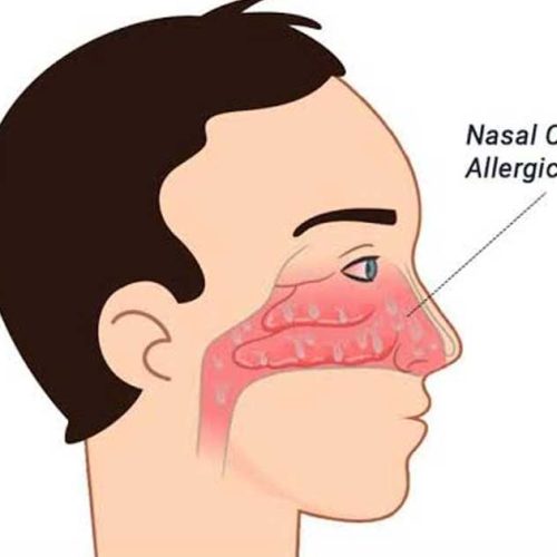 Rinitis Alergi: Reaksi Alergi Berlebihan pada Hidung