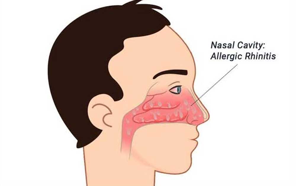 Read more about the article Rinitis Alergi: Reaksi Alergi Berlebihan pada Hidung