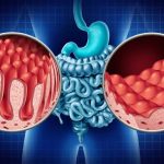 Mengenal Celiac Disease: Ketika Sistem Imun Menyerang Gluten
