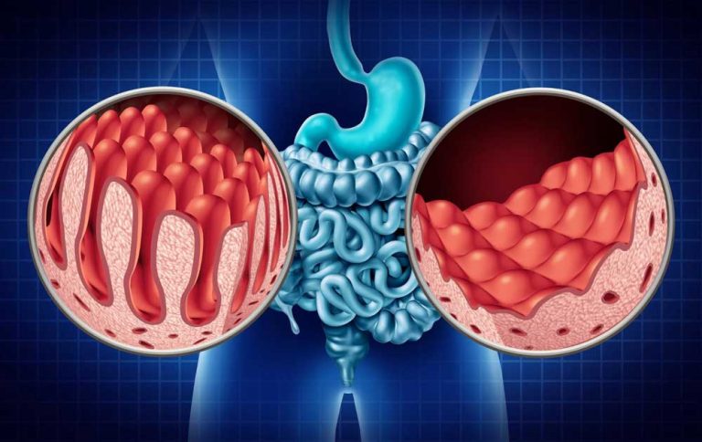 Mengenal Celiac Disease: Ketika Sistem Imun Menyerang Gluten